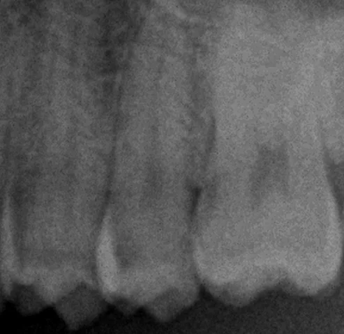 遠方から白い詰め物での治療を求めて・・・｜坂寄歯科医院（取手市藤代） - 画像2