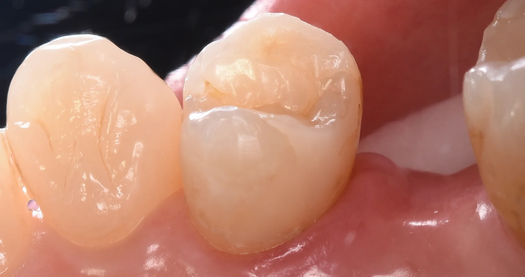 ダイレクトボンディング術後4年での補修修復｜坂寄歯科医院（取手市藤代） - 画像5