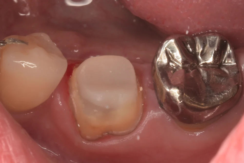 神経の治療後をセラミックで。｜坂寄歯科医院（取手市藤代） - 画像2