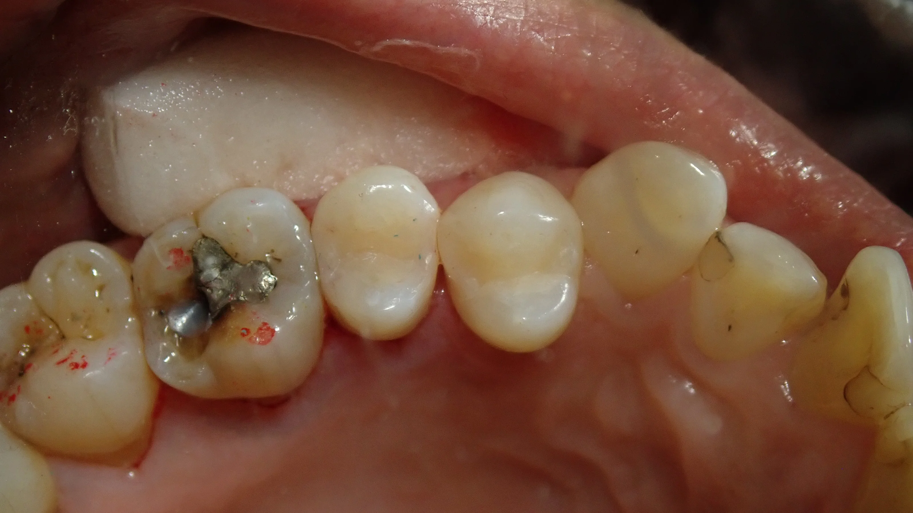 白い部分的な詰め物｜坂寄歯科医院（取手市藤代） - 画像5