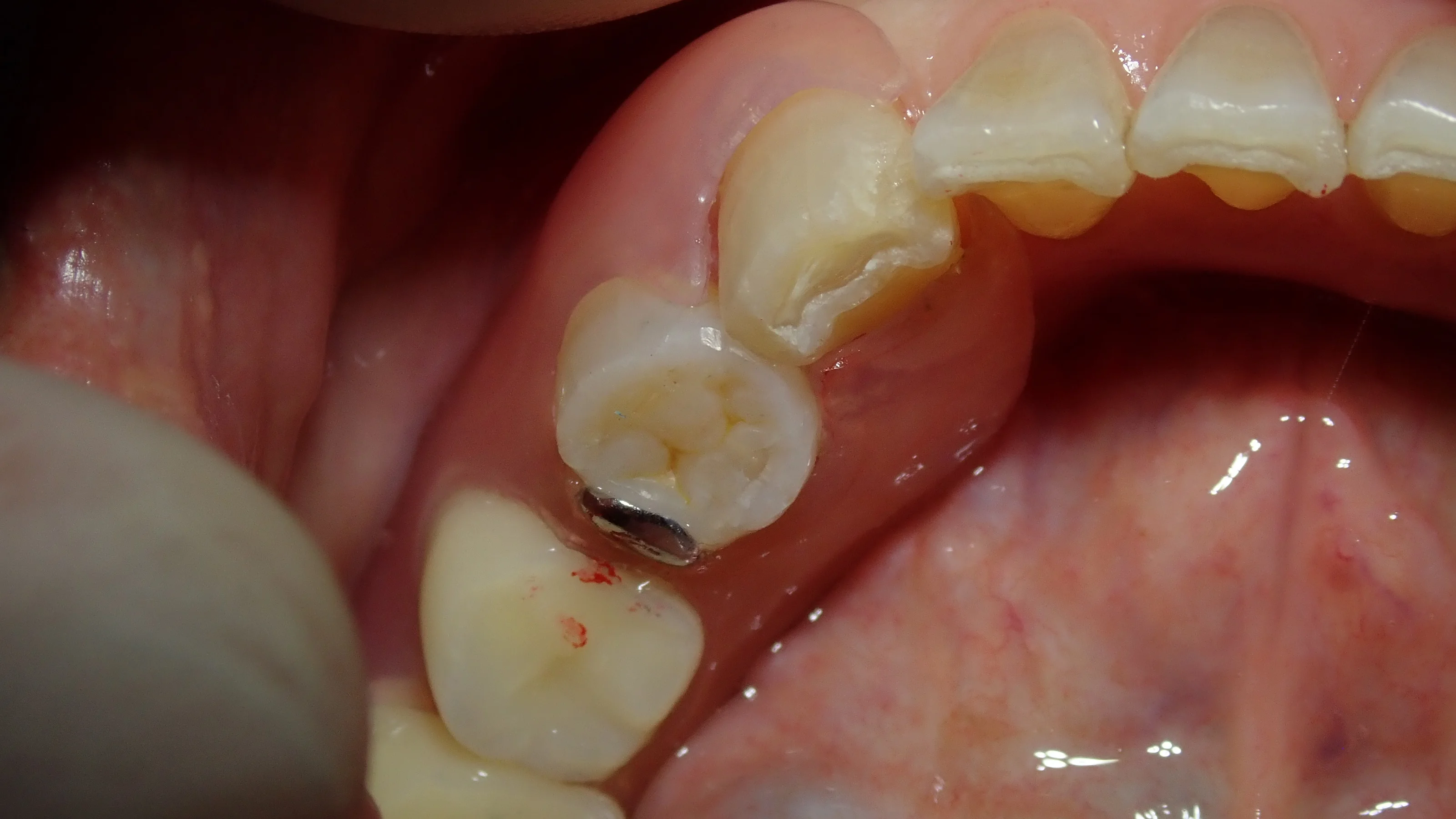 左下奥歯白い詰め物｜坂寄歯科医院（取手市藤代） - 画像3