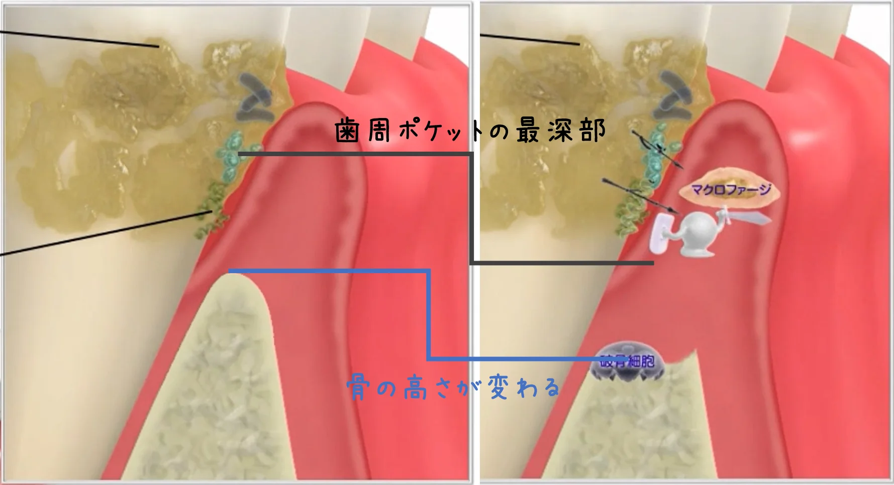 歯槽骨が溶けて骨の高さが下がった断面図（歯周病の進行）