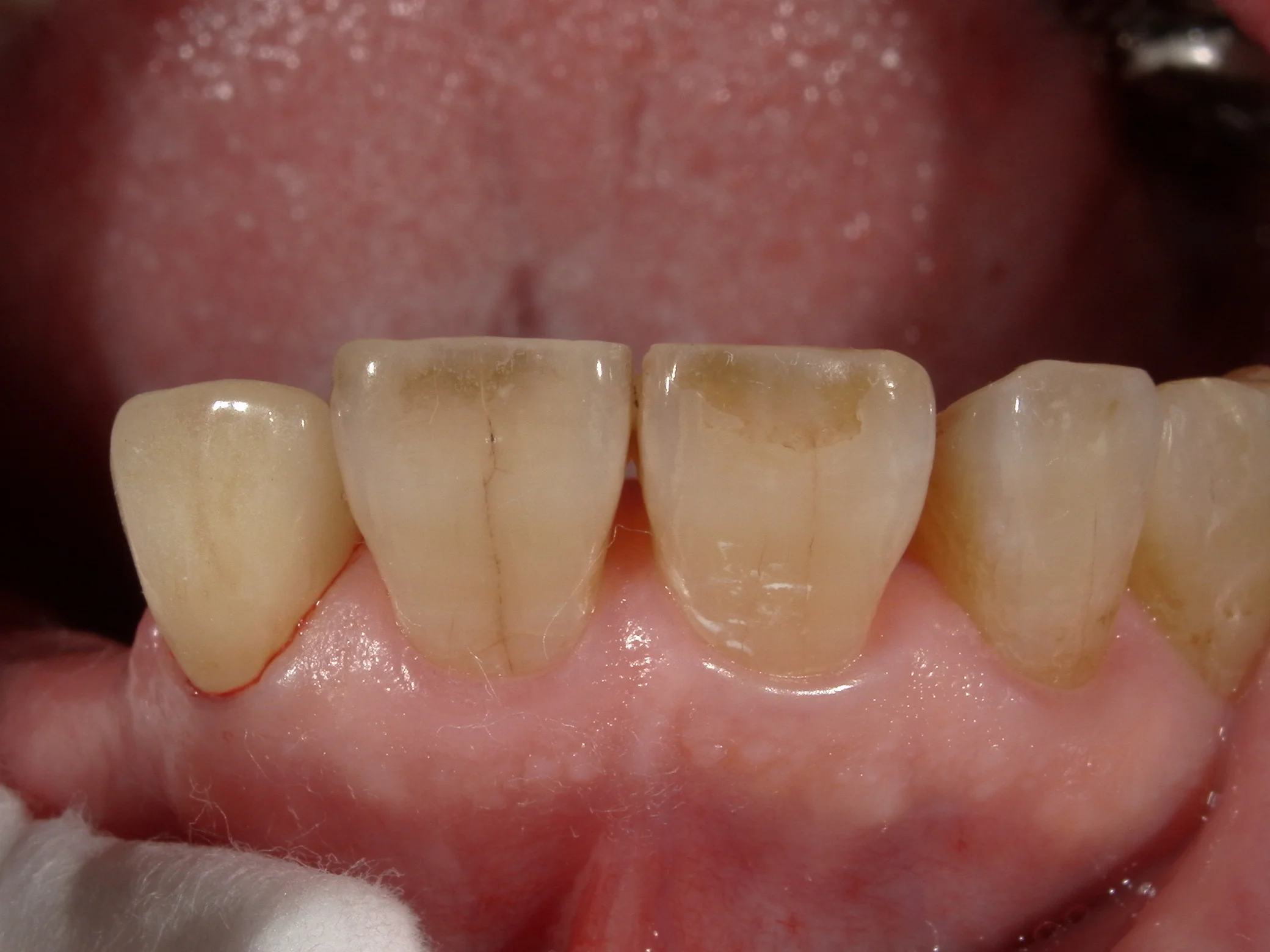 セラミックでの色の再現度を上げるために･･･｜坂寄歯科医院（取手市藤代） - 画像3