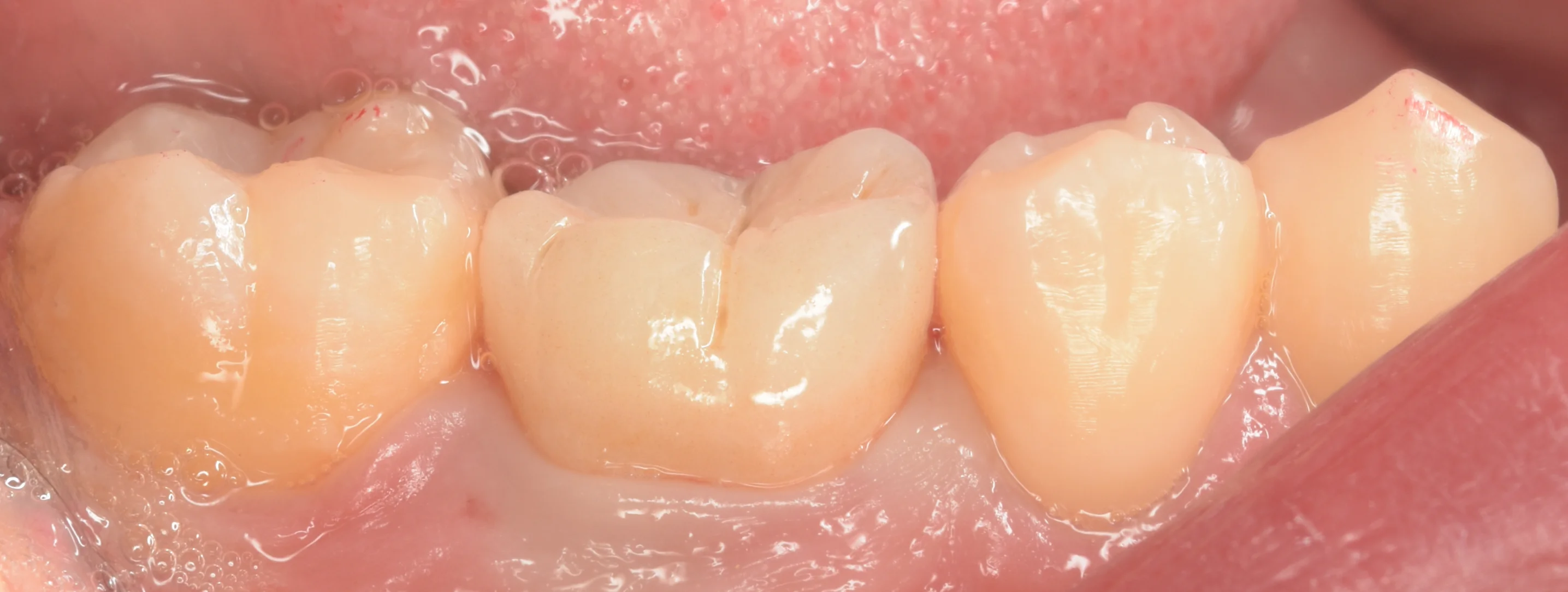 セラミックの被せ物｜坂寄歯科医院（取手市藤代） - 画像5