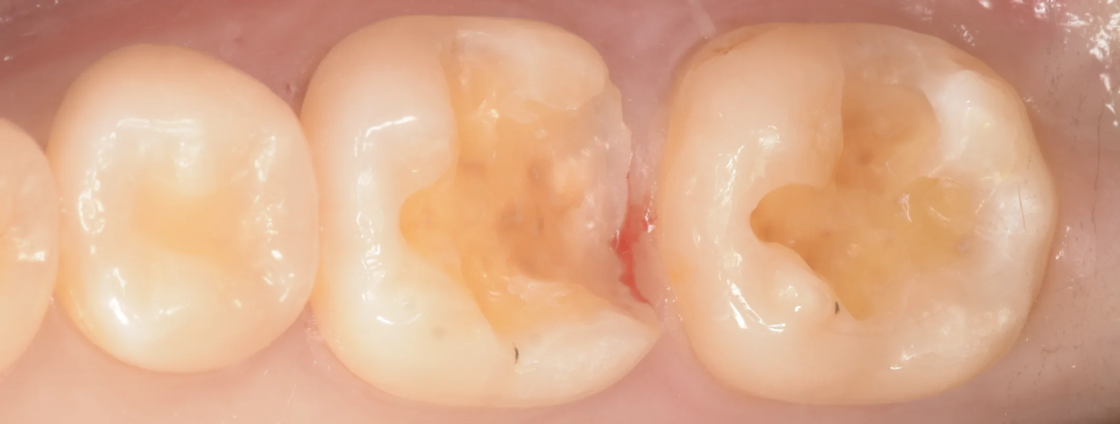 歯科医師の方のCAD/CAMインレーを治療。｜坂寄歯科医院（取手市藤代） - 画像3