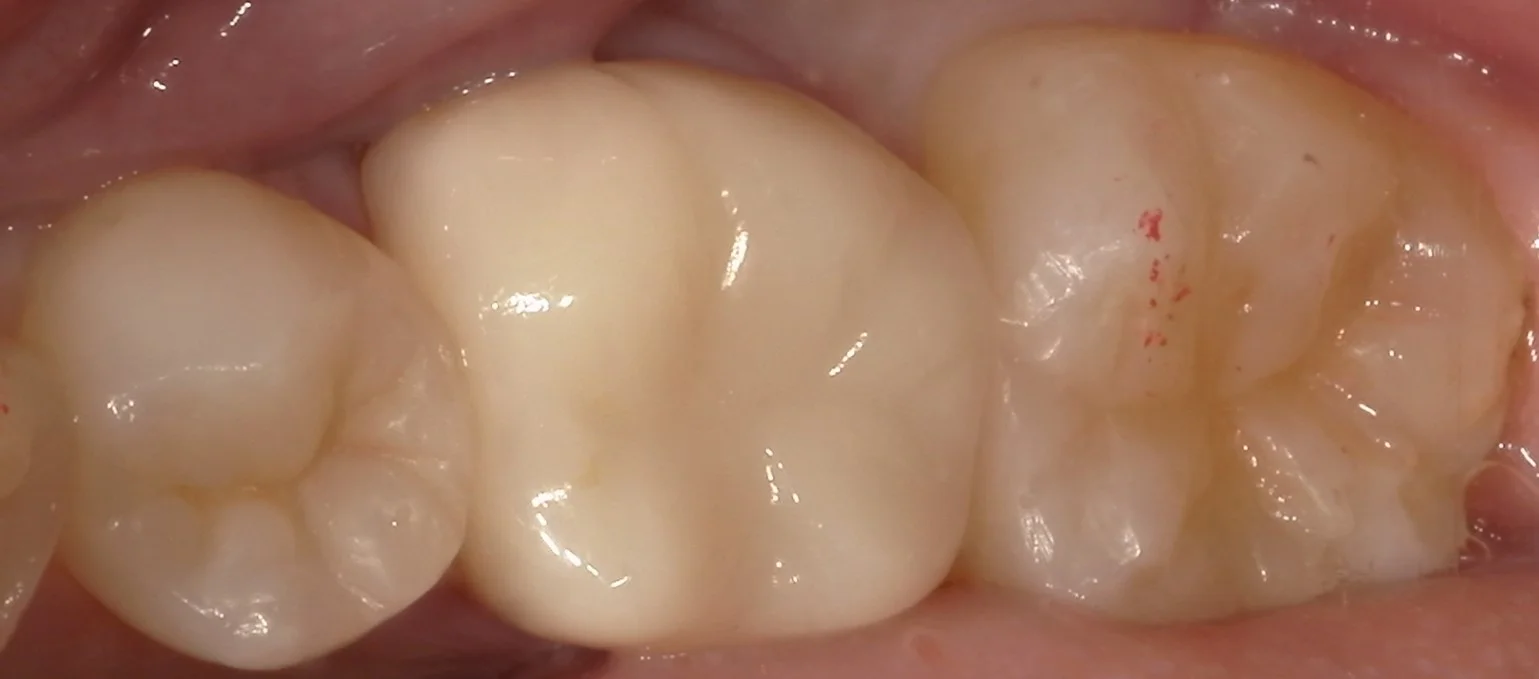 ワンデートリートメントを始めました。｜坂寄歯科医院（取手市藤代） - 画像2