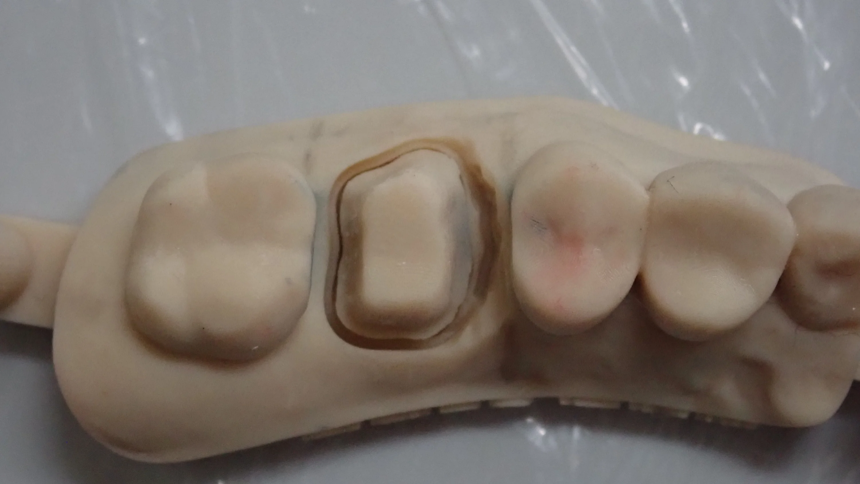 被せ物が無調整で入るとすっごく気持ちいい。｜坂寄歯科医院（取手市藤代） - 画像2