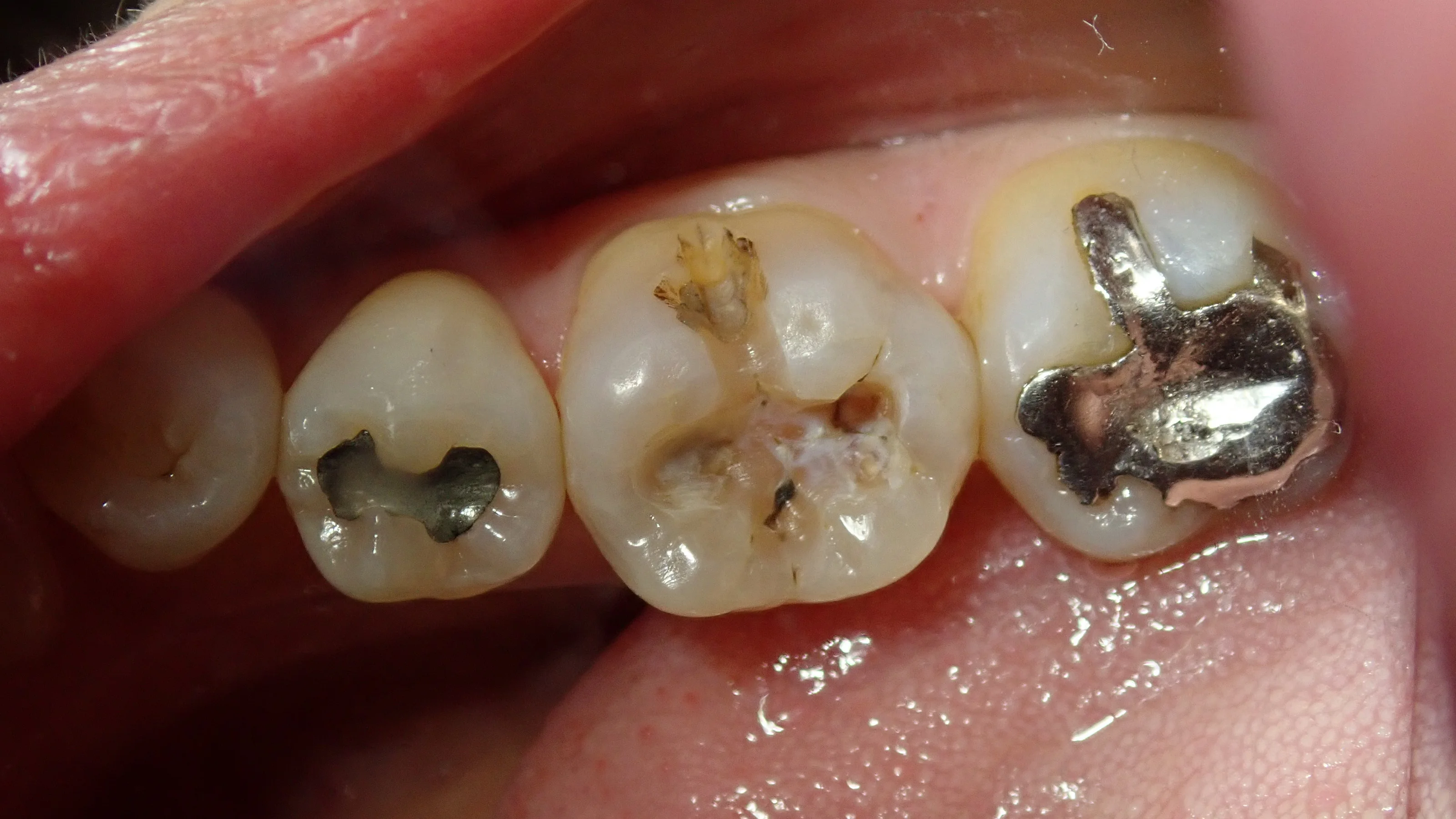 コンポジットレジン|坂寄歯科医院(取手市藤代) - 画像2