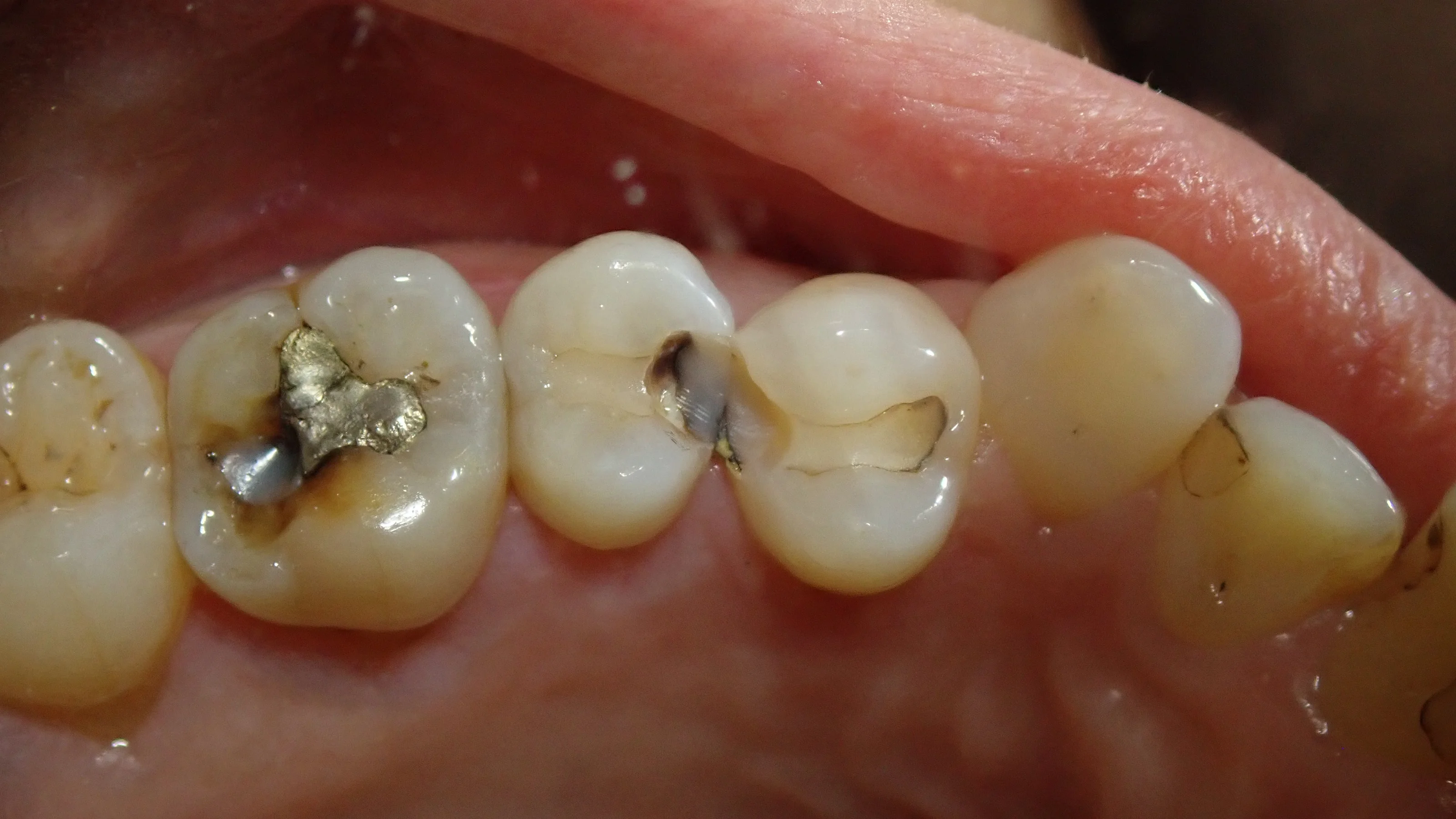 白い部分的な詰め物｜坂寄歯科医院（取手市藤代） - 画像2