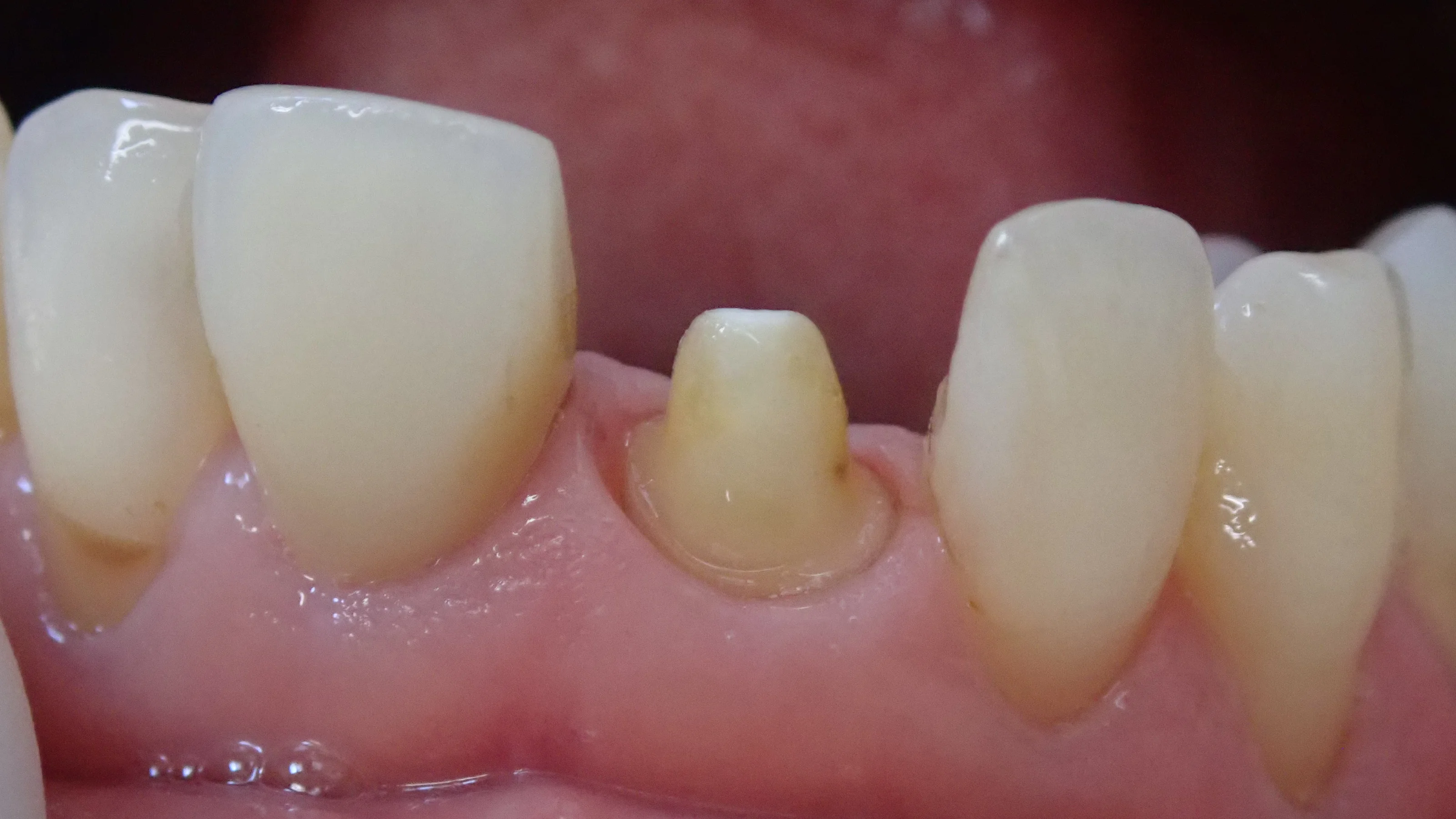 仮歯へのこだわり。その２｜坂寄歯科医院（取手市藤代） - 画像2