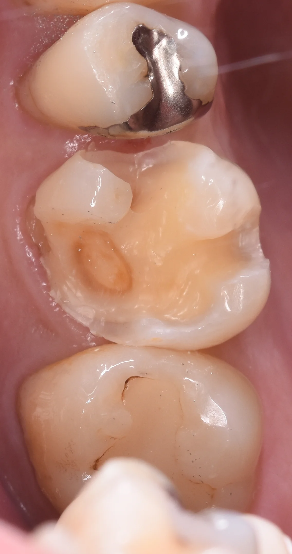 金属を白い詰め物に。｜坂寄歯科医院（取手市藤代） - 画像2