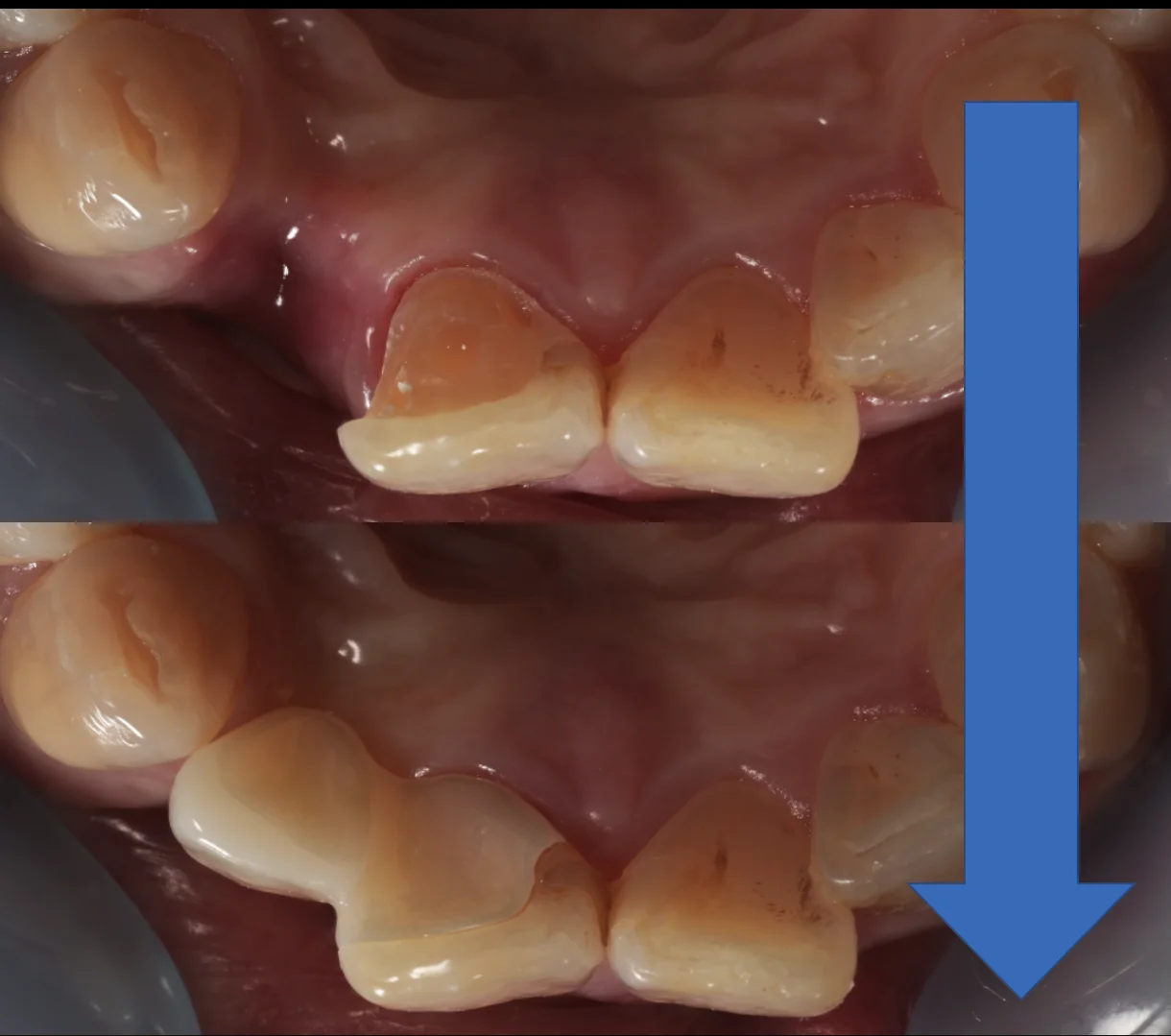 審美治療+歯質保存：延長セラミックブリッジ｜坂寄歯科医院（取手市藤代） - 画像7