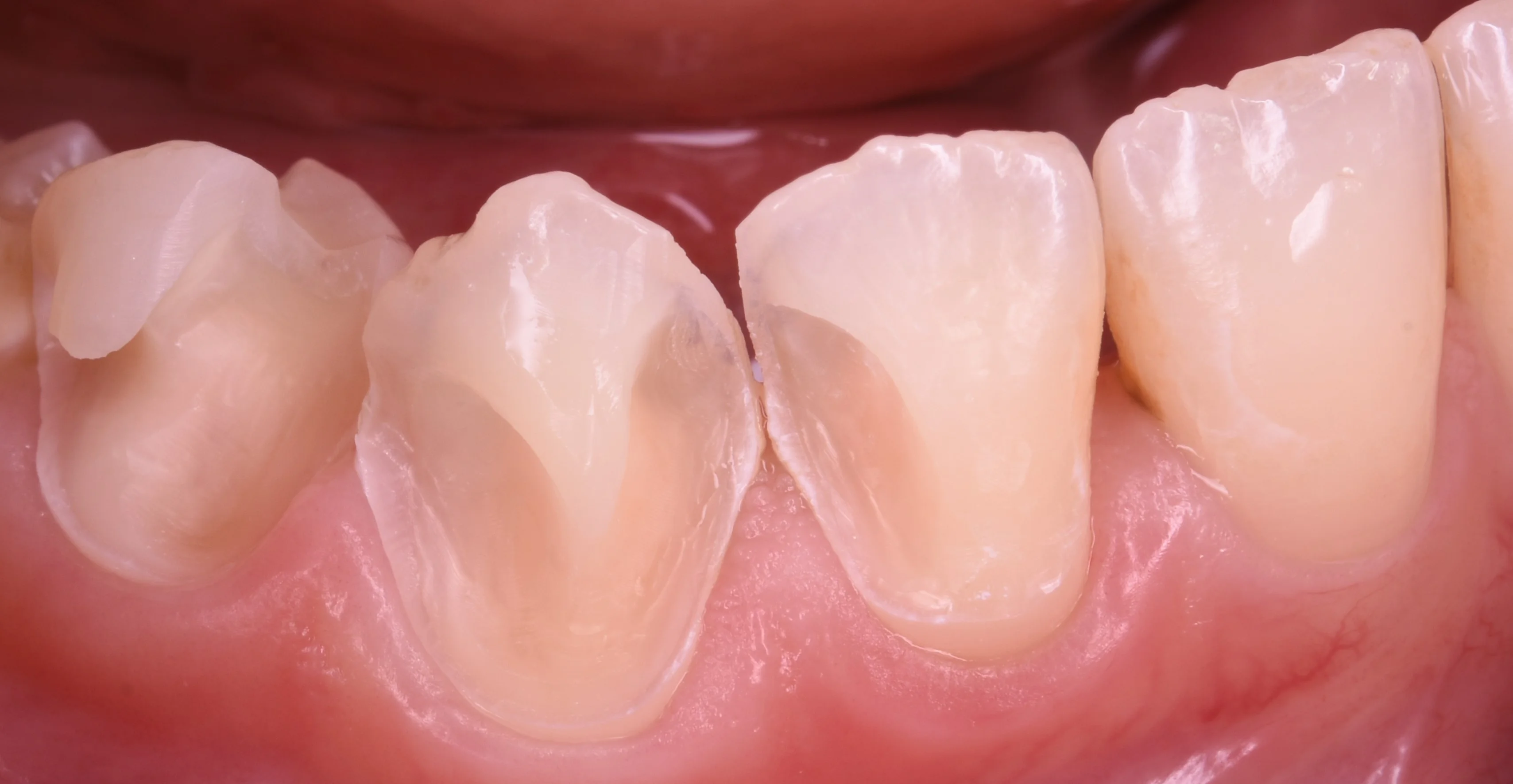 前歯を纏めて白く。｜坂寄歯科医院（取手市藤代） - 画像2