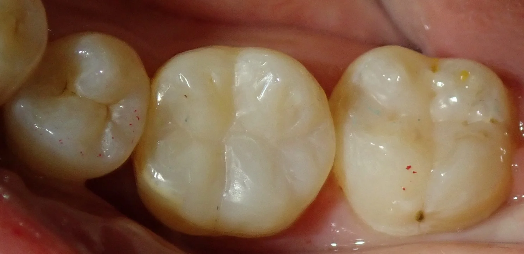 奥歯の白い詰め物｜坂寄歯科医院（取手市藤代） - 画像4