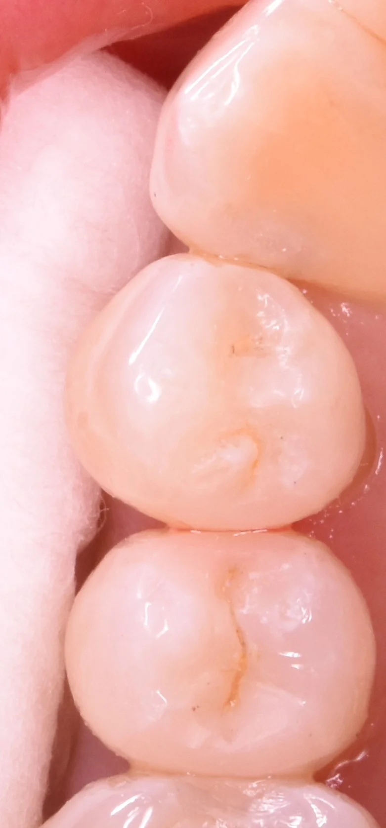 奥歯の歯並びが悪くなってしまっている所の治療｜坂寄歯科医院（取手市藤代） - 画像5