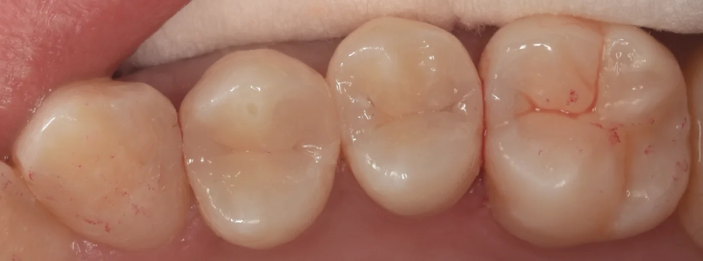 通常の保険診療。｜坂寄歯科医院（取手市藤代） - 画像4