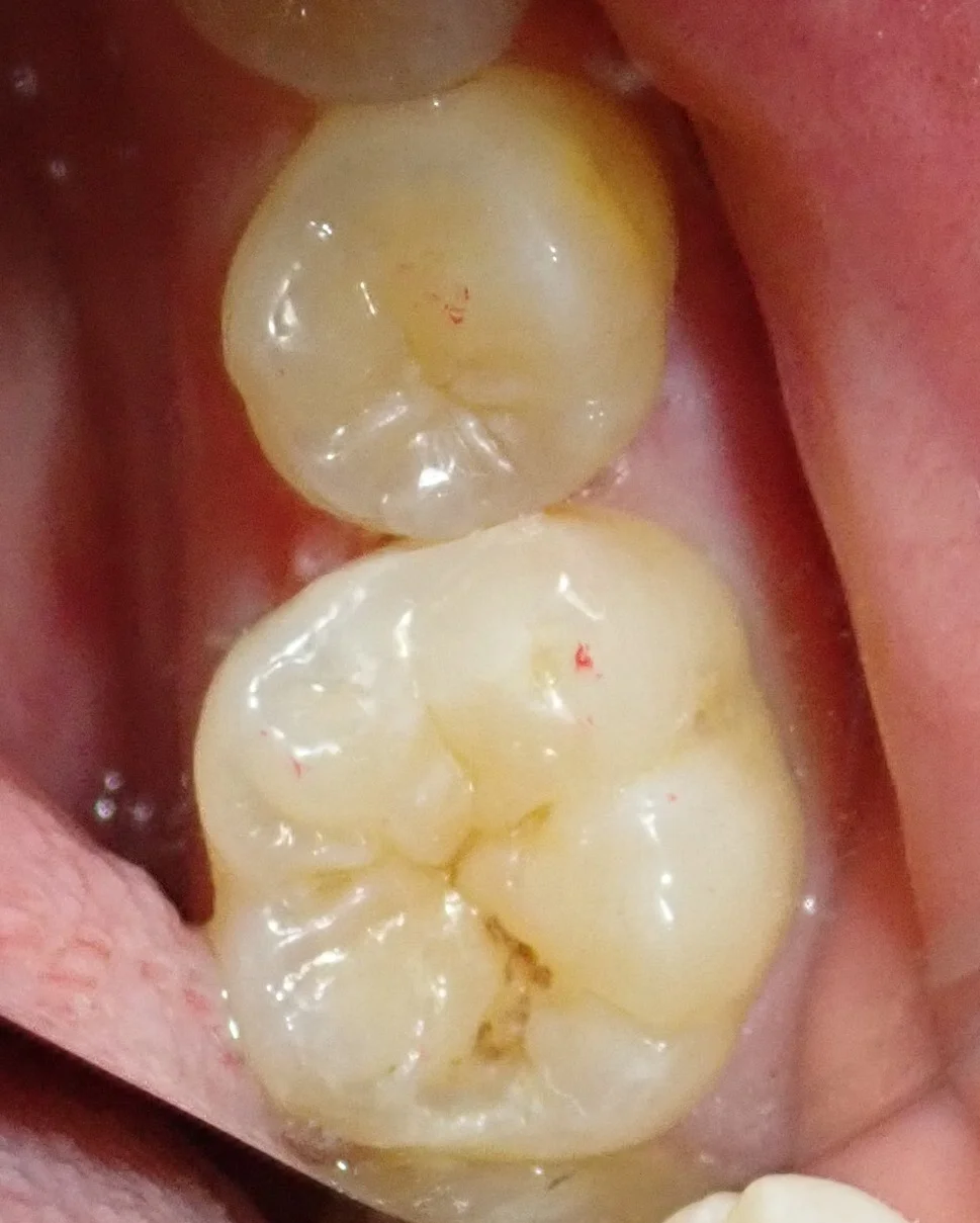 虫歯はない･･･?本当に･･･?｜坂寄歯科医院（取手市藤代） - 画像4