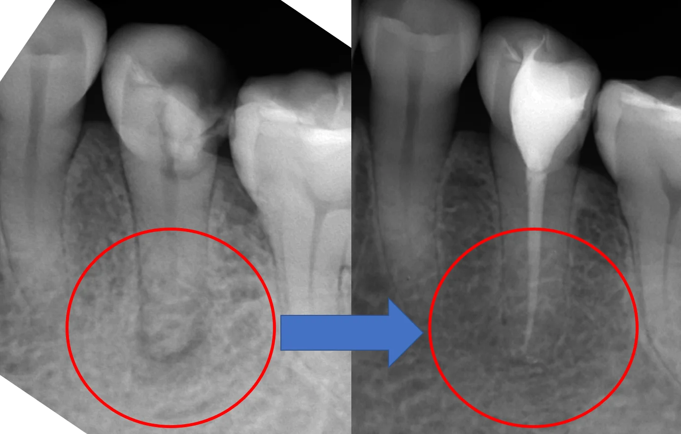 詰め物が欠けたまま放置した結果･･･｜坂寄歯科医院（取手市藤代） - 画像4