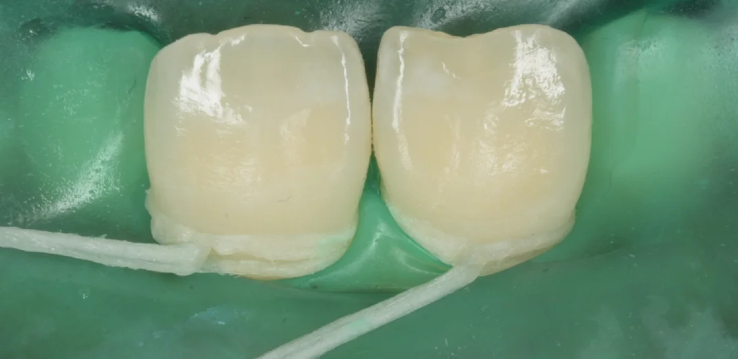 遠方よりICON治療を求めて・・・|坂寄歯科医院(取手市藤代) - 画像3