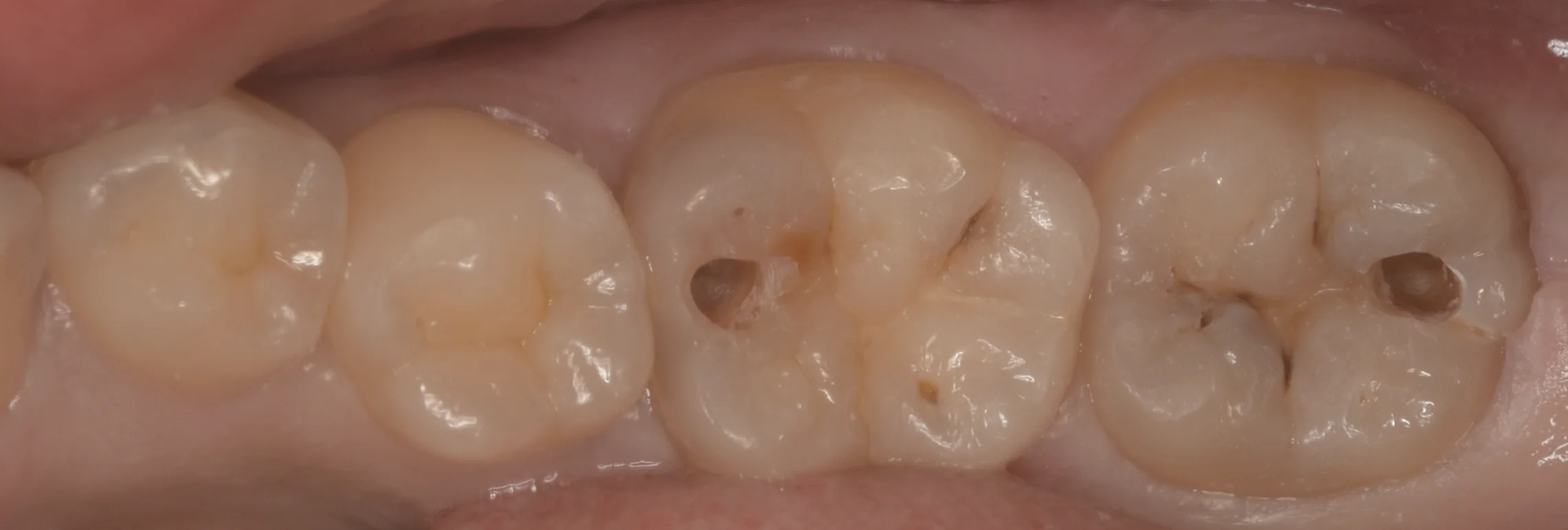 浦安から来た方をダイレクトボンディングで。｜坂寄歯科医院（取手市藤代） - 画像2