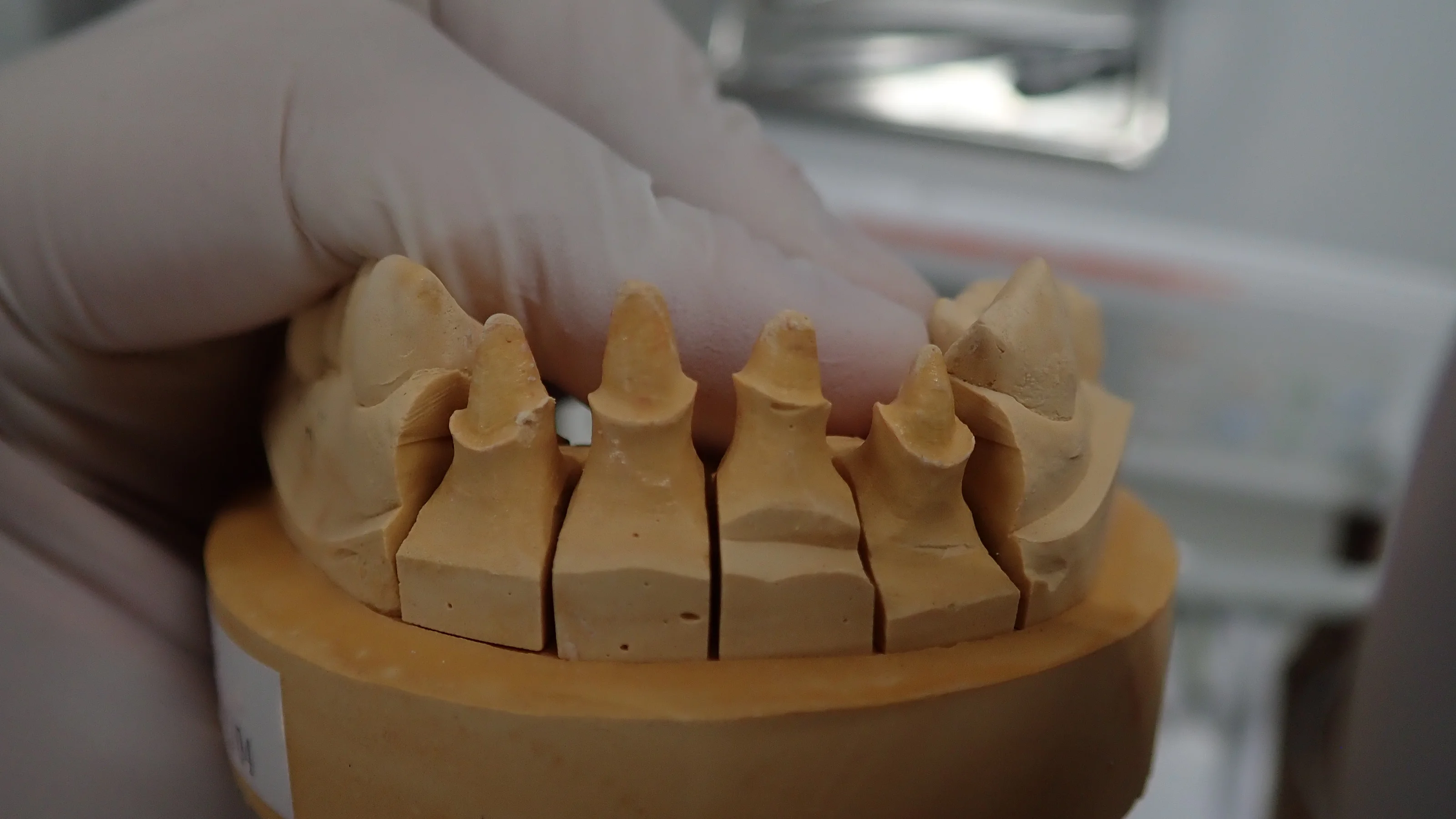 上の前歯の自費診療(セラミック)|坂寄歯科医院(取手市藤代) - 画像3