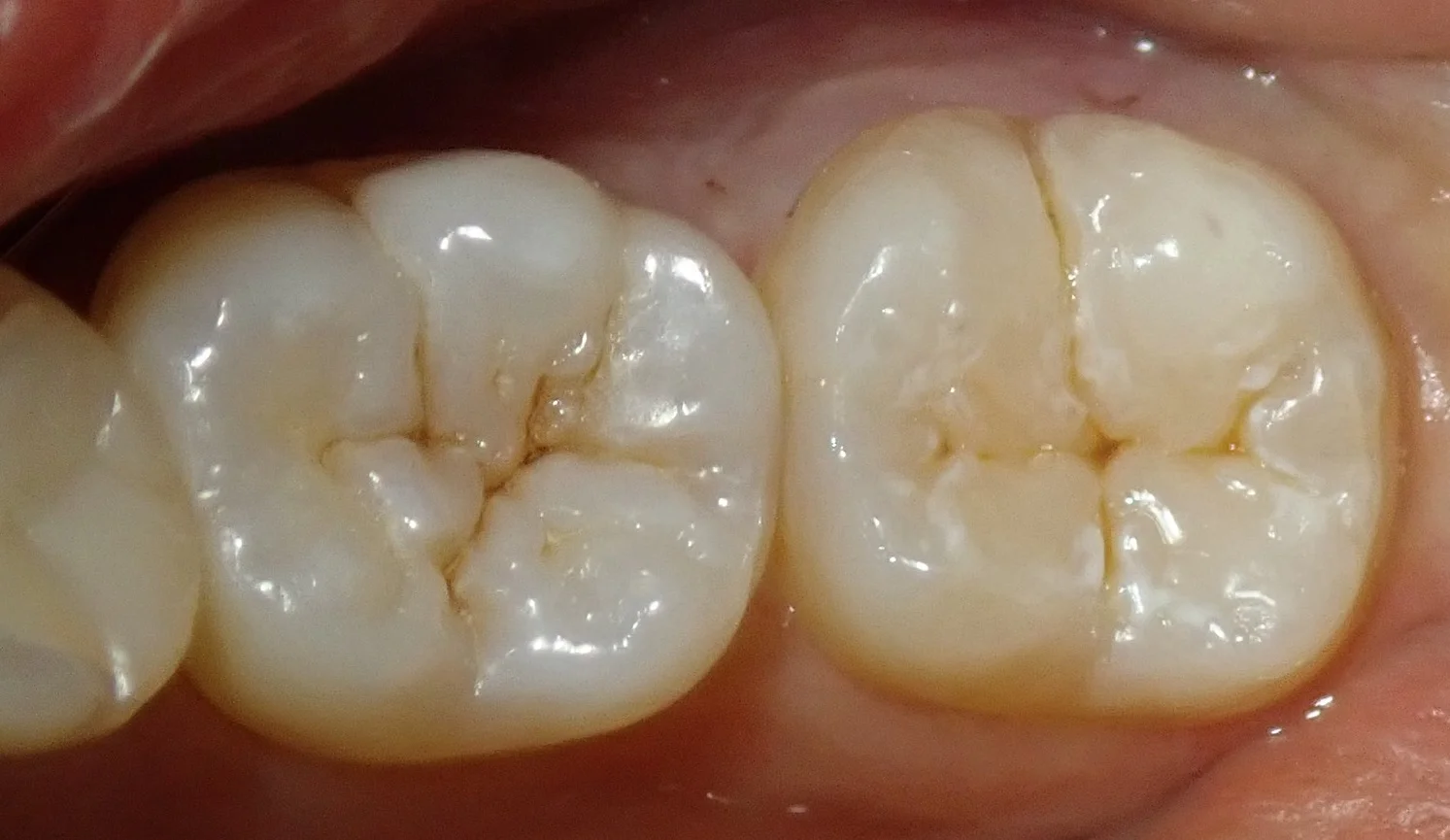 左下奥歯の白い詰め物｜坂寄歯科医院（取手市藤代） - 画像3
