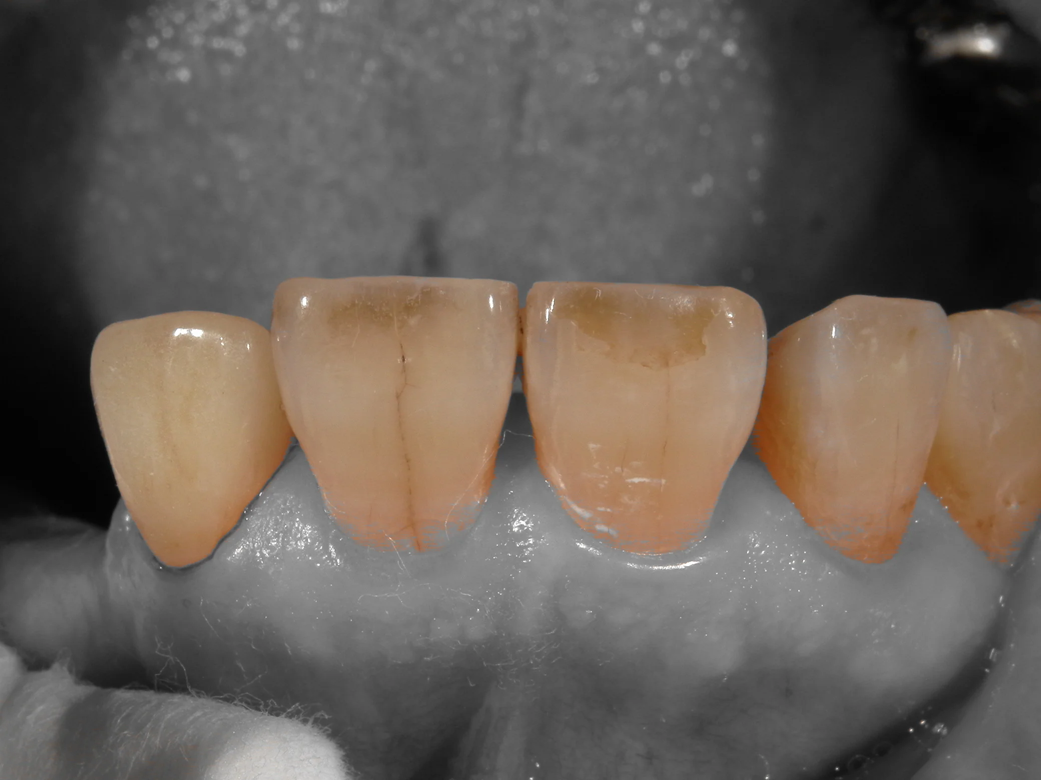 セラミックでの色の再現度を上げるために･･･｜坂寄歯科医院（取手市藤代） - 画像4