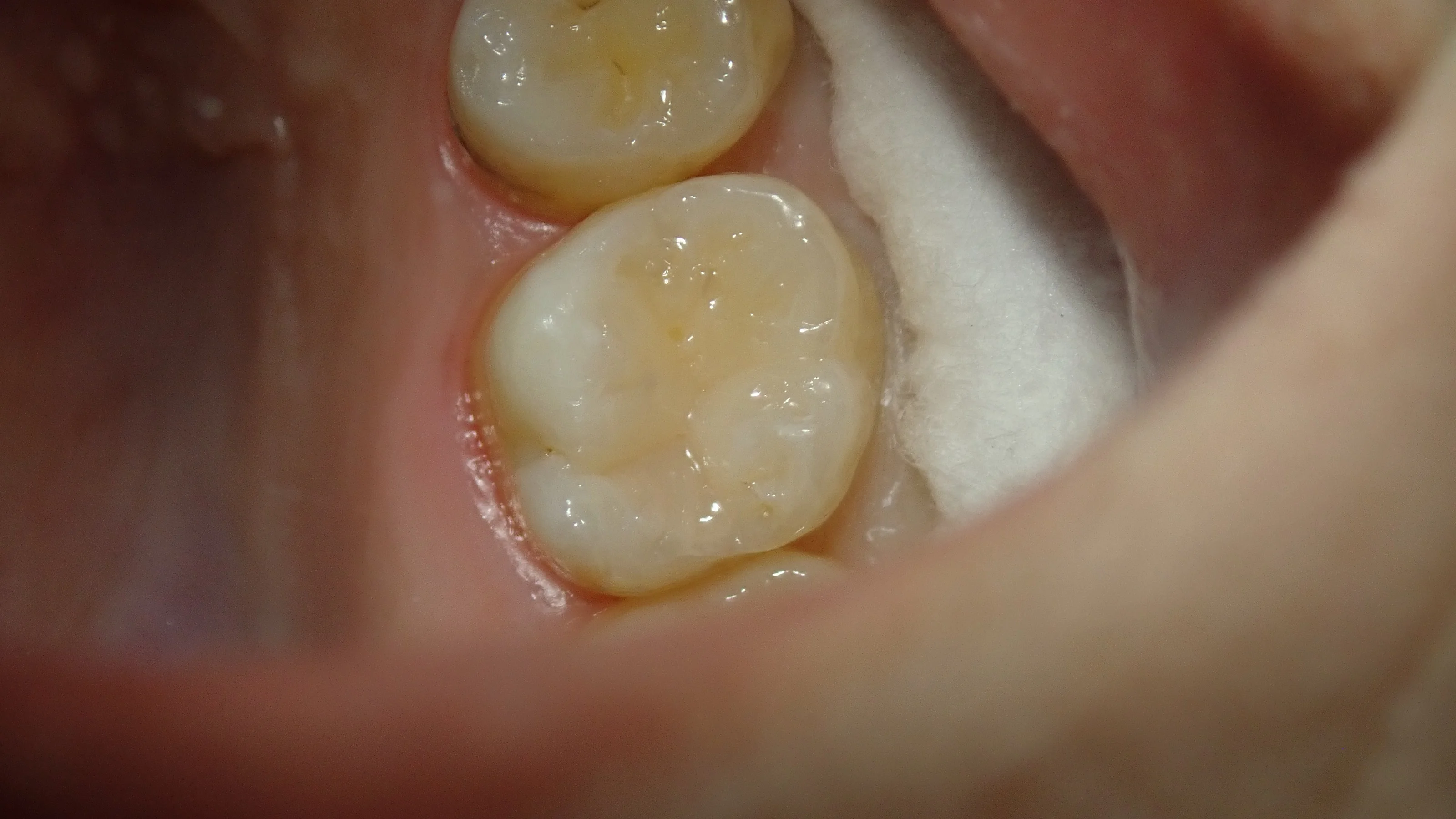 シールドレストレーション･･･？｜坂寄歯科医院（取手市藤代） - 画像5