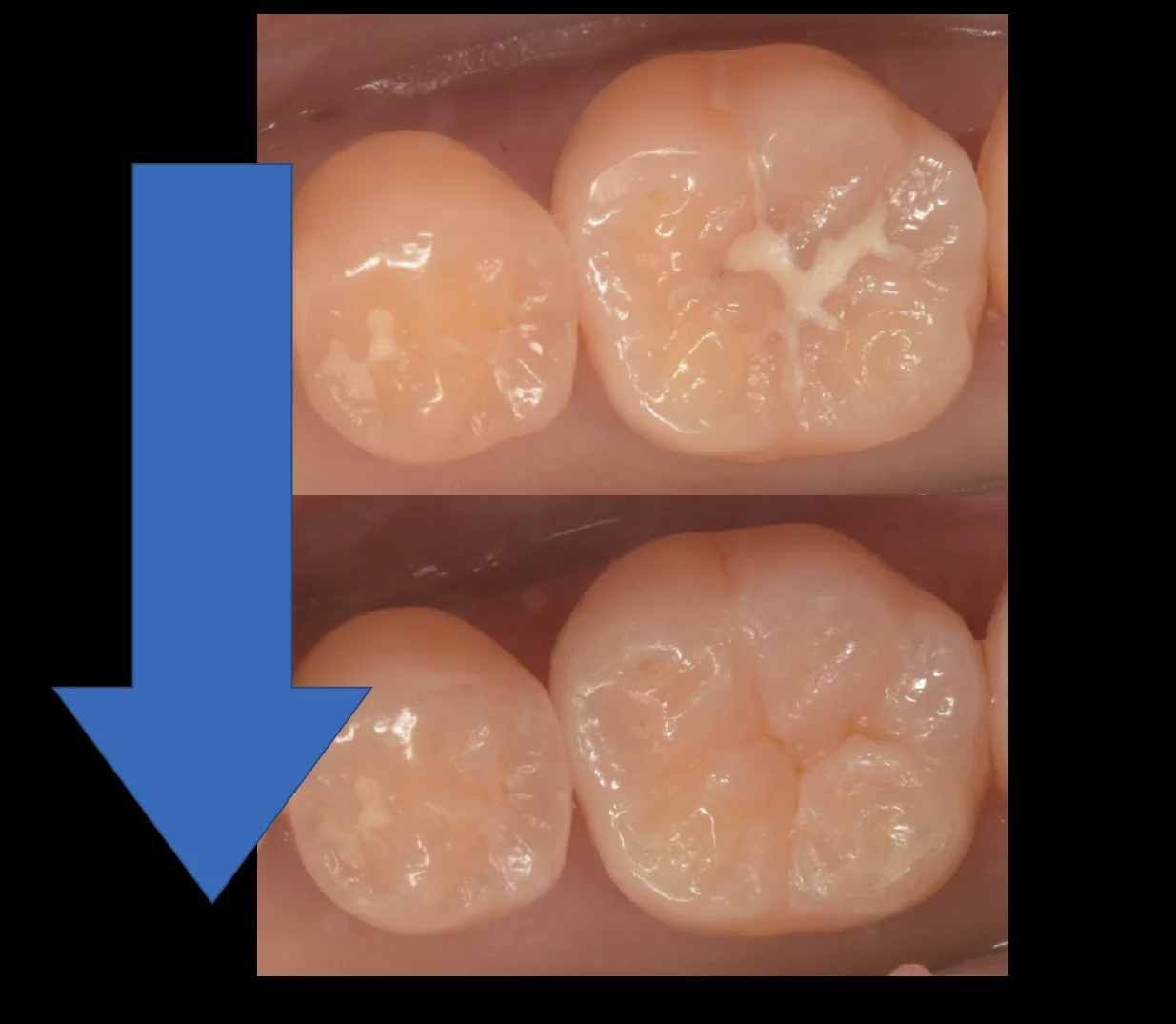 様子を見ていた所が進んだため治療介入。｜坂寄歯科医院（取手市藤代） - 画像5