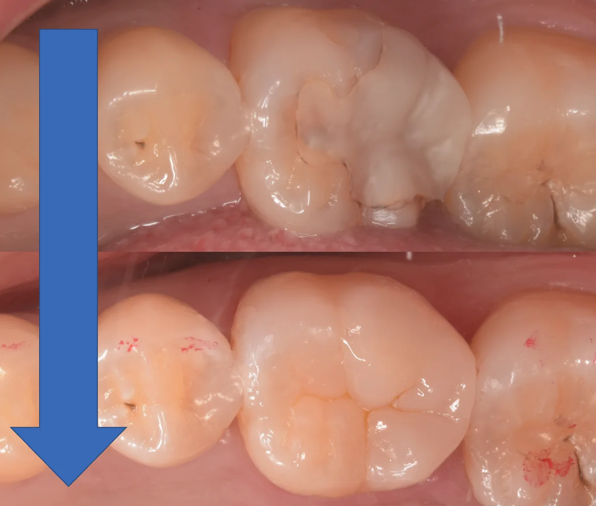 歯科医師の方のCAD/CAMインレーを治療。｜坂寄歯科医院（取手市藤代） - 画像5