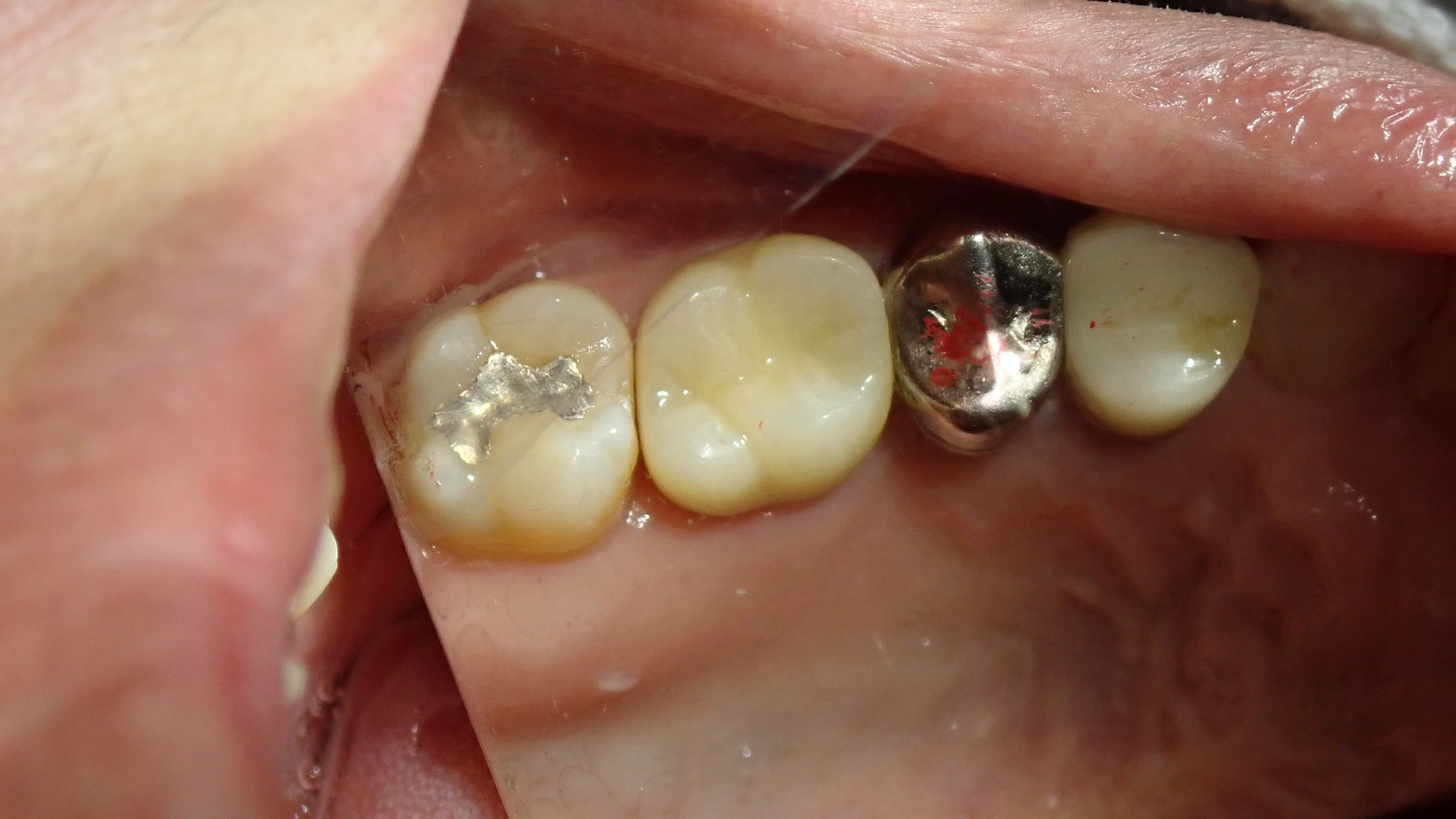 被せ物が無調整で入るとすっごく気持ちいい。｜坂寄歯科医院（取手市藤代） - 画像4