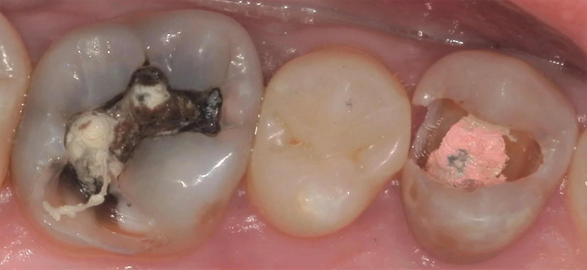 遠方から来院の方を白い詰め物にて治療。｜坂寄歯科医院（取手市藤代） - 画像5
