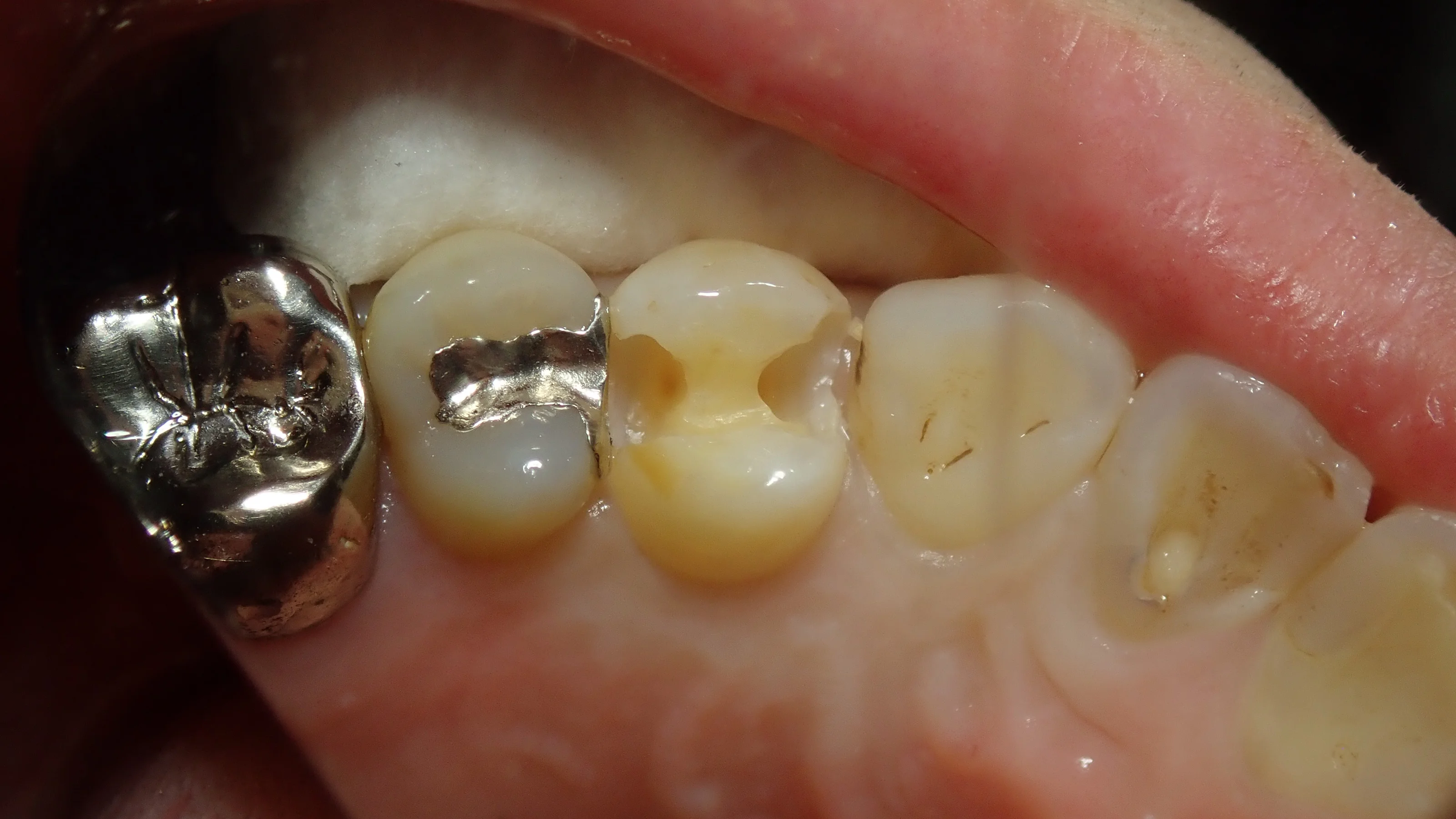 小さい奥歯(小臼歯)の白い詰め物｜坂寄歯科医院（取手市藤代） - 画像5