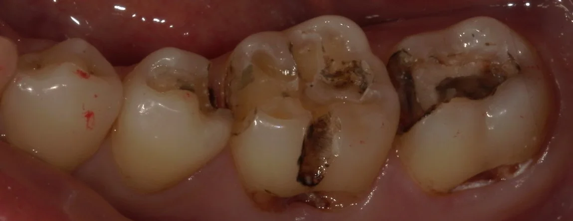 遠方から纏めて治療を希望の方。｜坂寄歯科医院（取手市藤代） - 画像2