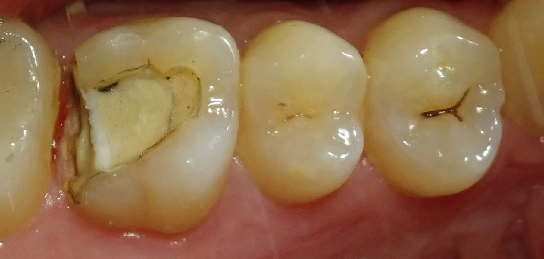 テフロンテープを用いたレジン治療｜坂寄歯科医院（取手市藤代） - 画像2