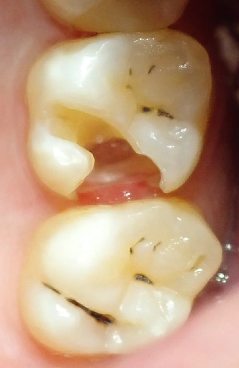 右上奥歯の治療｜坂寄歯科医院（取手市藤代） - 画像2