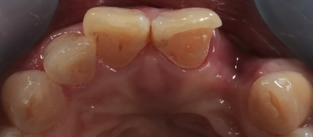 審美治療+歯質保存：延長セラミックブリッジ｜坂寄歯科医院（取手市藤代） - 画像3