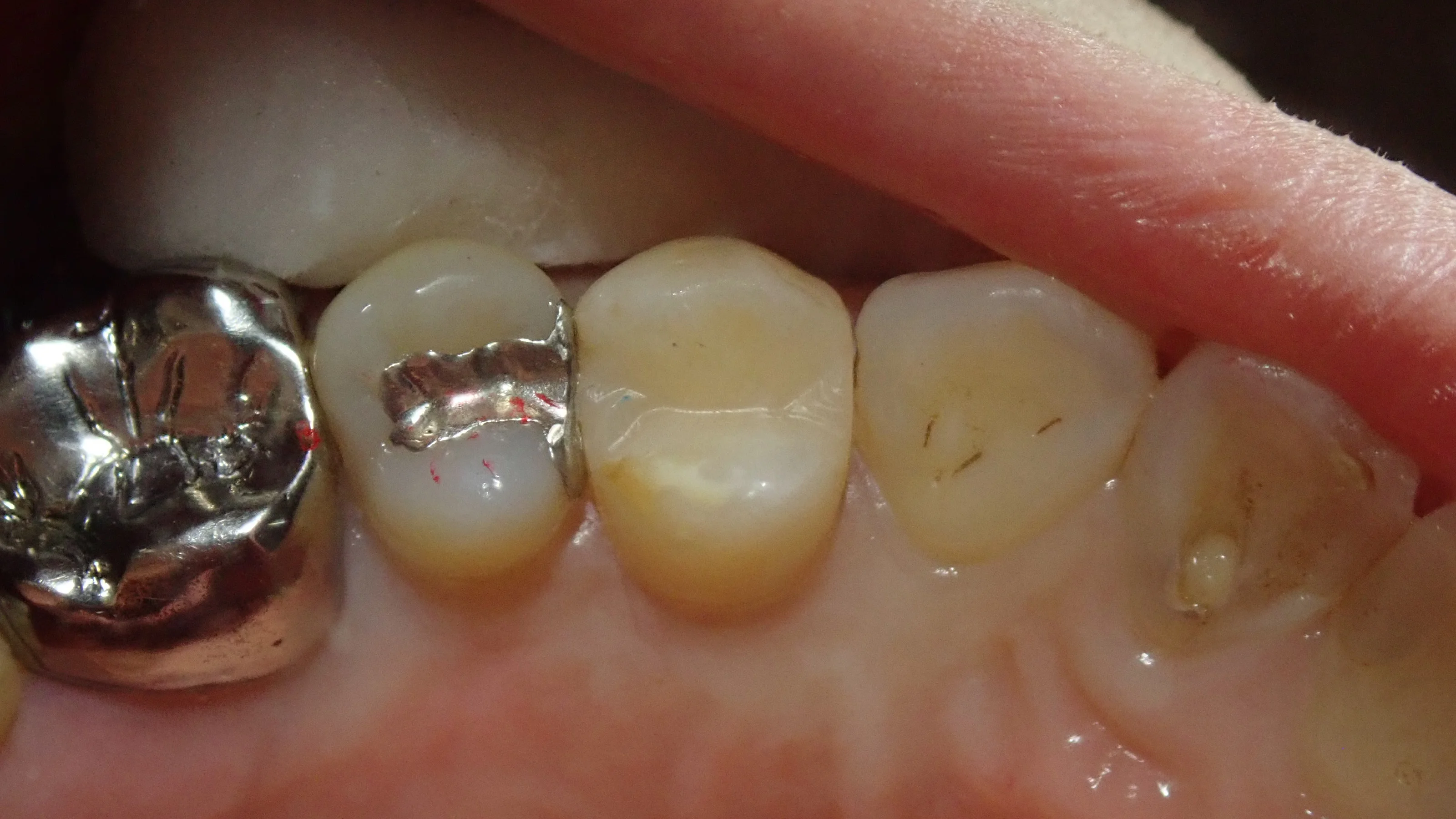 小さい奥歯(小臼歯)の白い詰め物｜坂寄歯科医院（取手市藤代） - 画像6