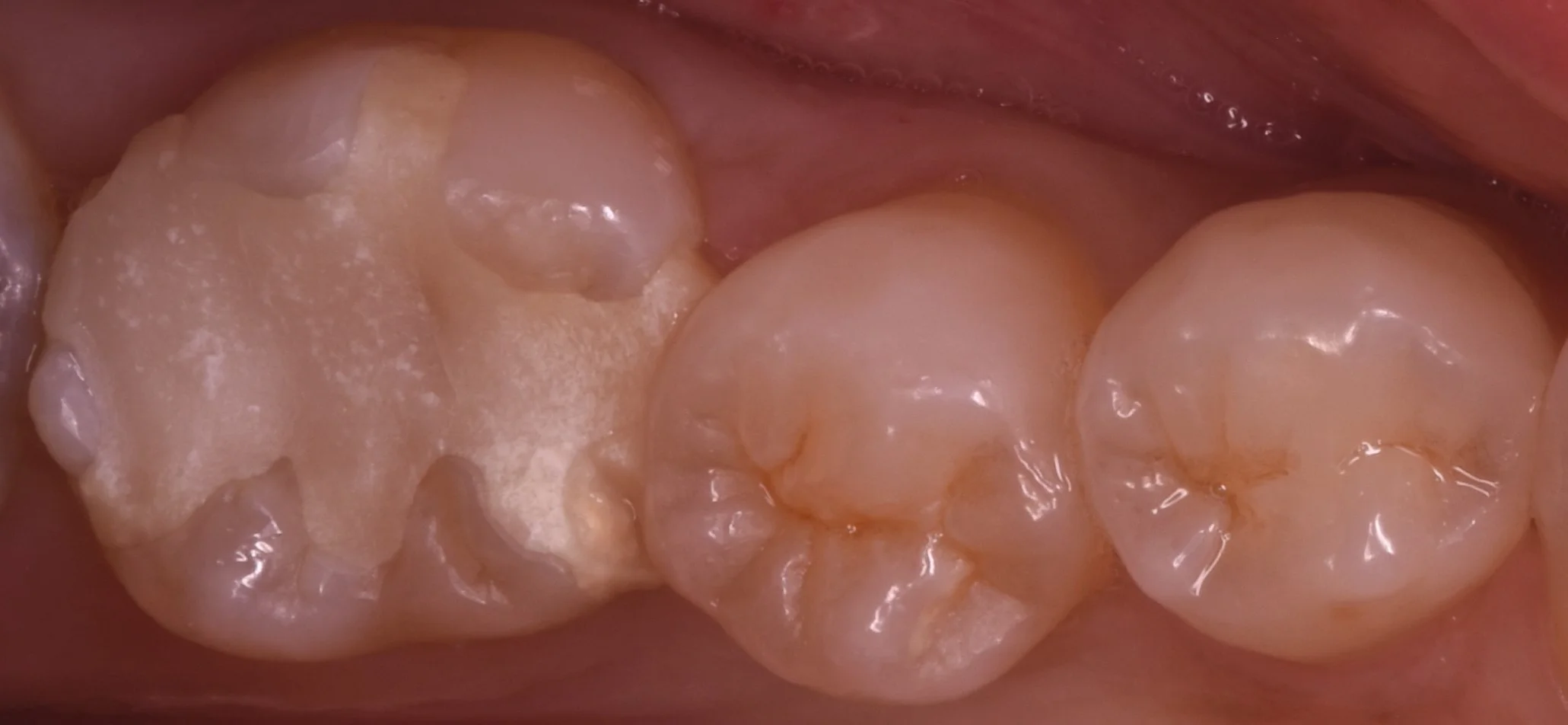 詰め物が脱離した所を即日で白い詰め物に。｜坂寄歯科医院（取手市藤代） - 画像2