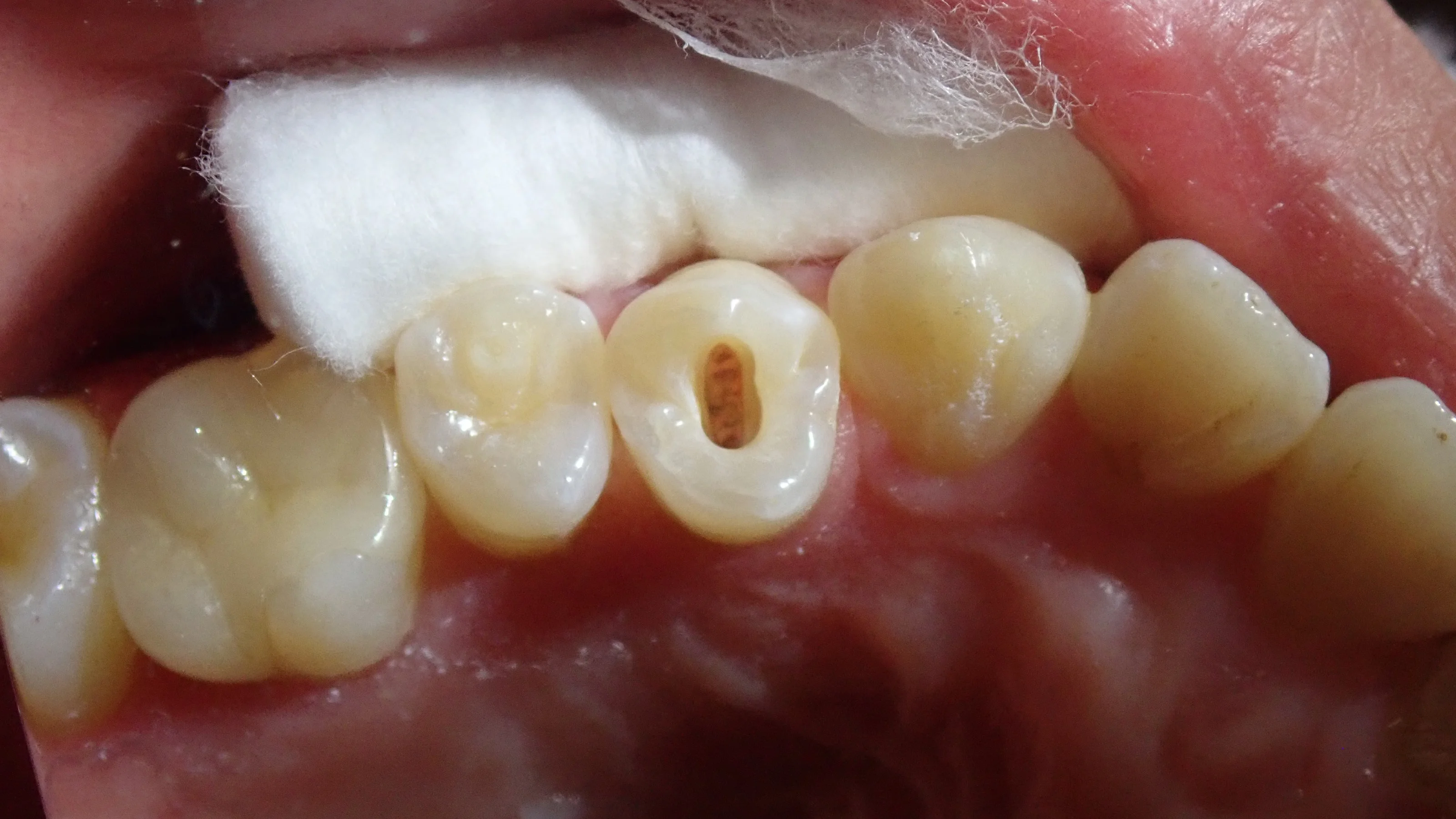 中心結節破折が原因で起こった神経の壊死を放置して、外部吸収が起こったケース｜坂寄歯科医院（取手市藤代） - 画像3
