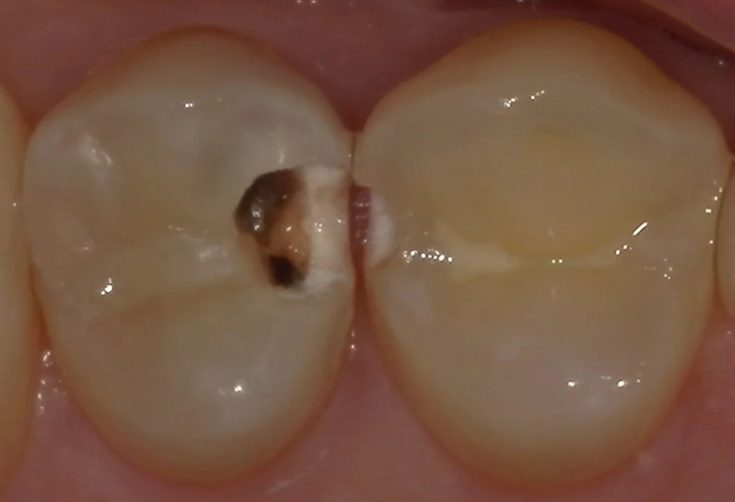 歯科医師の方の虫歯治療。｜坂寄歯科医院（取手市藤代） - 画像2
