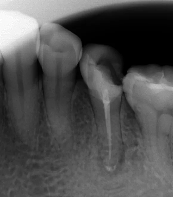 詰め物が欠けたまま放置した結果･･･｜坂寄歯科医院（取手市藤代） - 画像2
