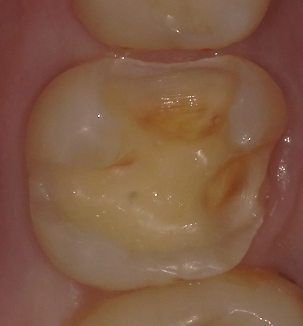 歯の側面も同時に治療したケース。｜坂寄歯科医院（取手市藤代） - 画像3