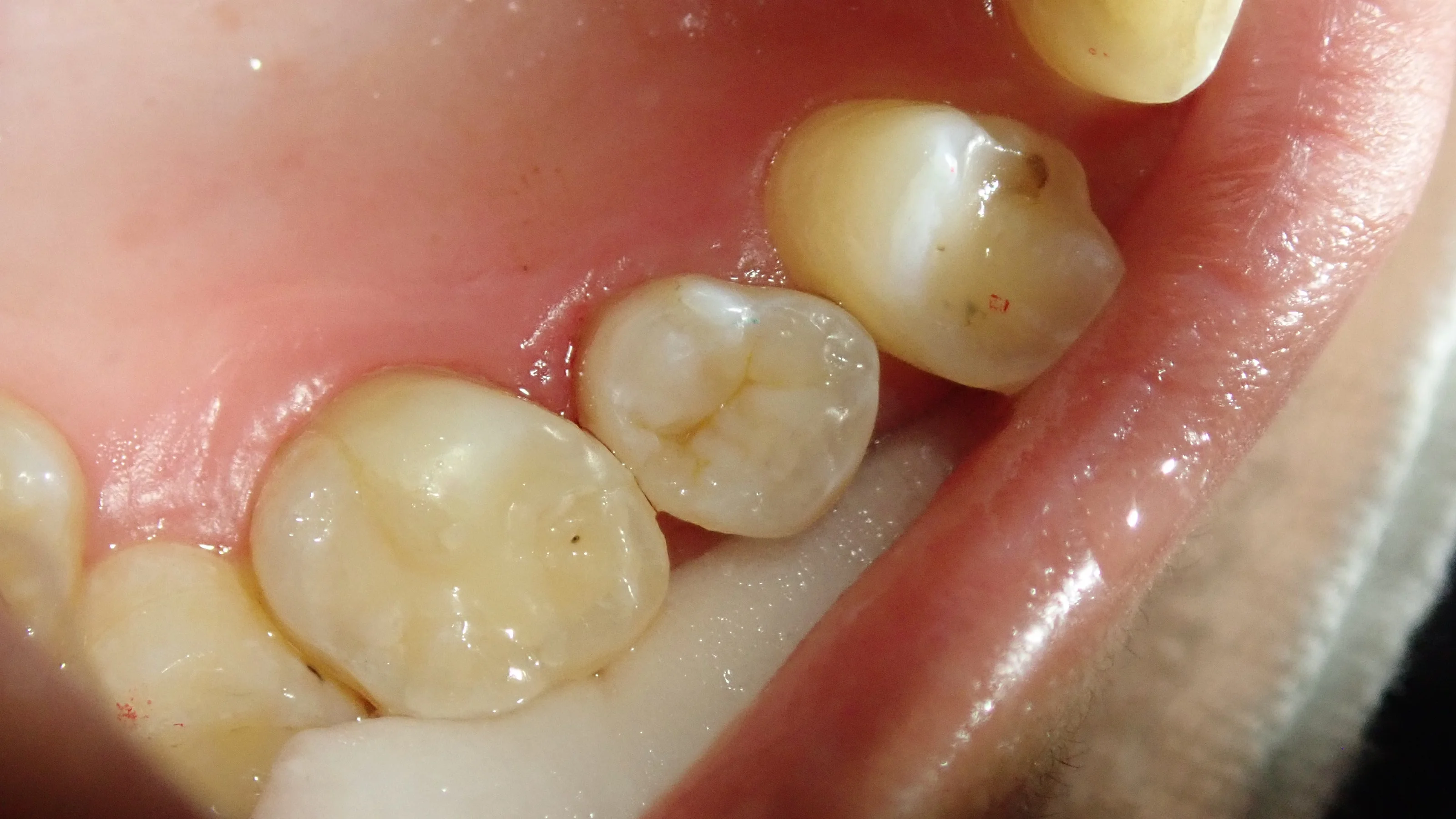 上顎小臼歯ダイレクトボンディング｜坂寄歯科医院（取手市藤代） - 画像3