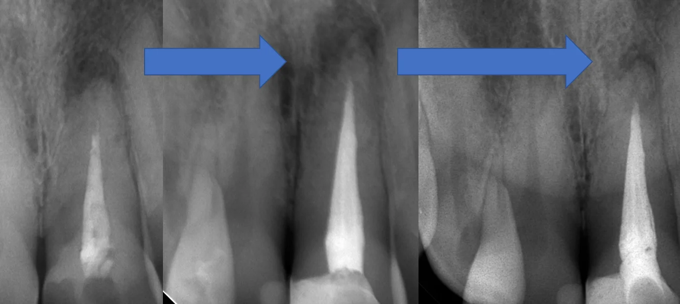 前歯の根管治療｜坂寄歯科医院（取手市藤代） - 画像4
