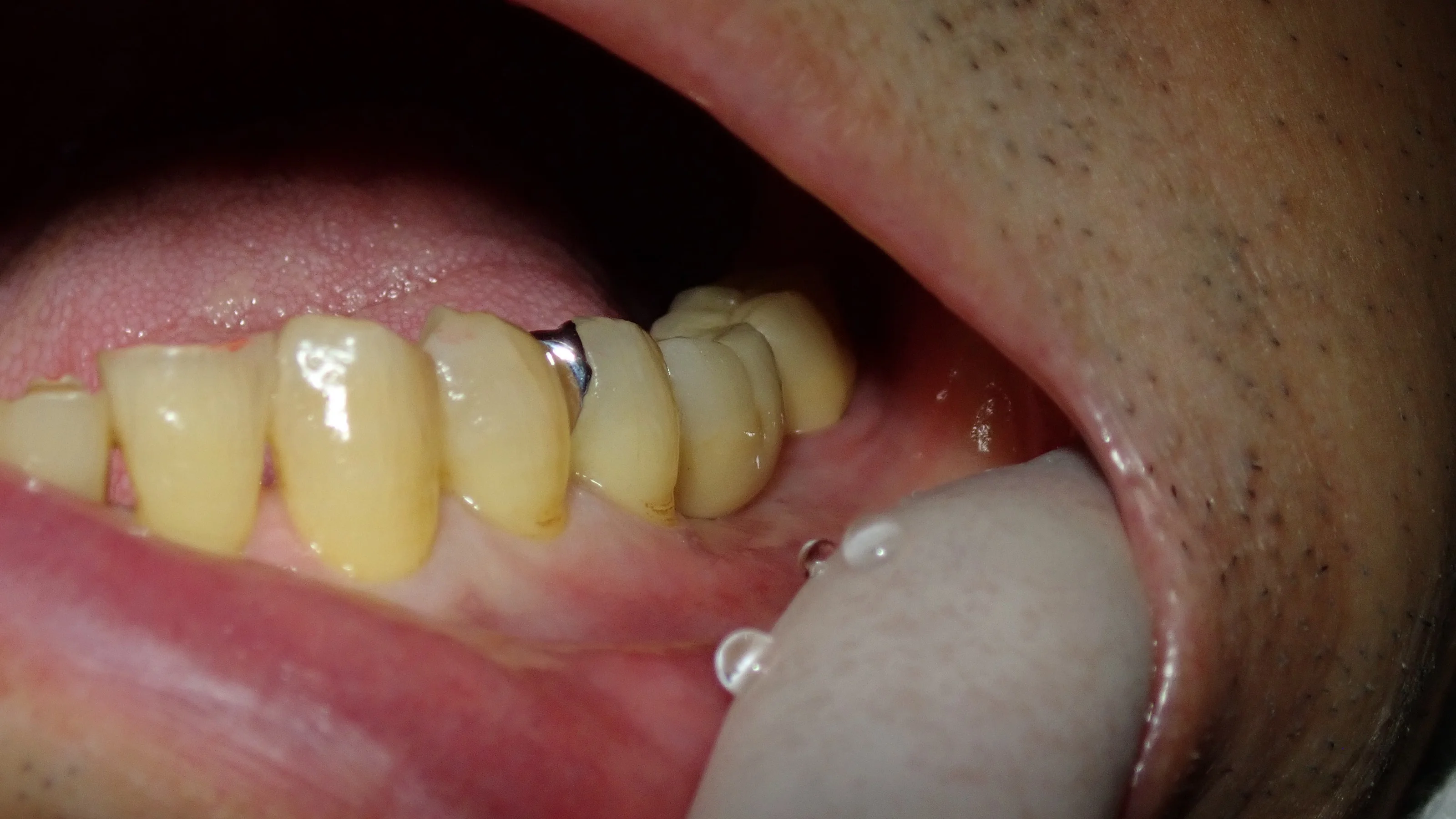 歯を可及的に温存したブリッジ｜坂寄歯科医院（取手市藤代） - 画像7