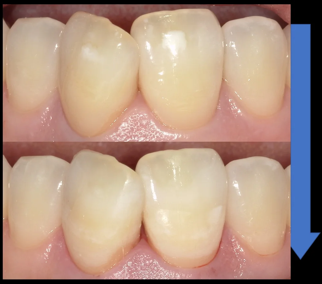 ICON治療(低侵襲ホワイトスポット改善治療)を始めました。|坂寄歯科医院(取手市藤代) - 画像6