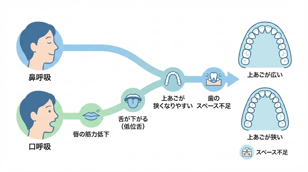 口呼吸（お口ポカン）が、唇の筋力低下、舌の低位（低位舌）、上あごの幅の発育、歯が並ぶスペース不足へつながる流れを示した図解イラスト。小児の歯ならびと口腔機能の関係をわかりやすく説明。