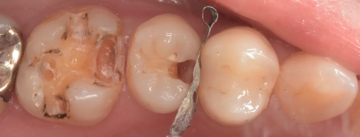 歯科医師の方を治療。｜坂寄歯科医院（取手市藤代） - 画像2