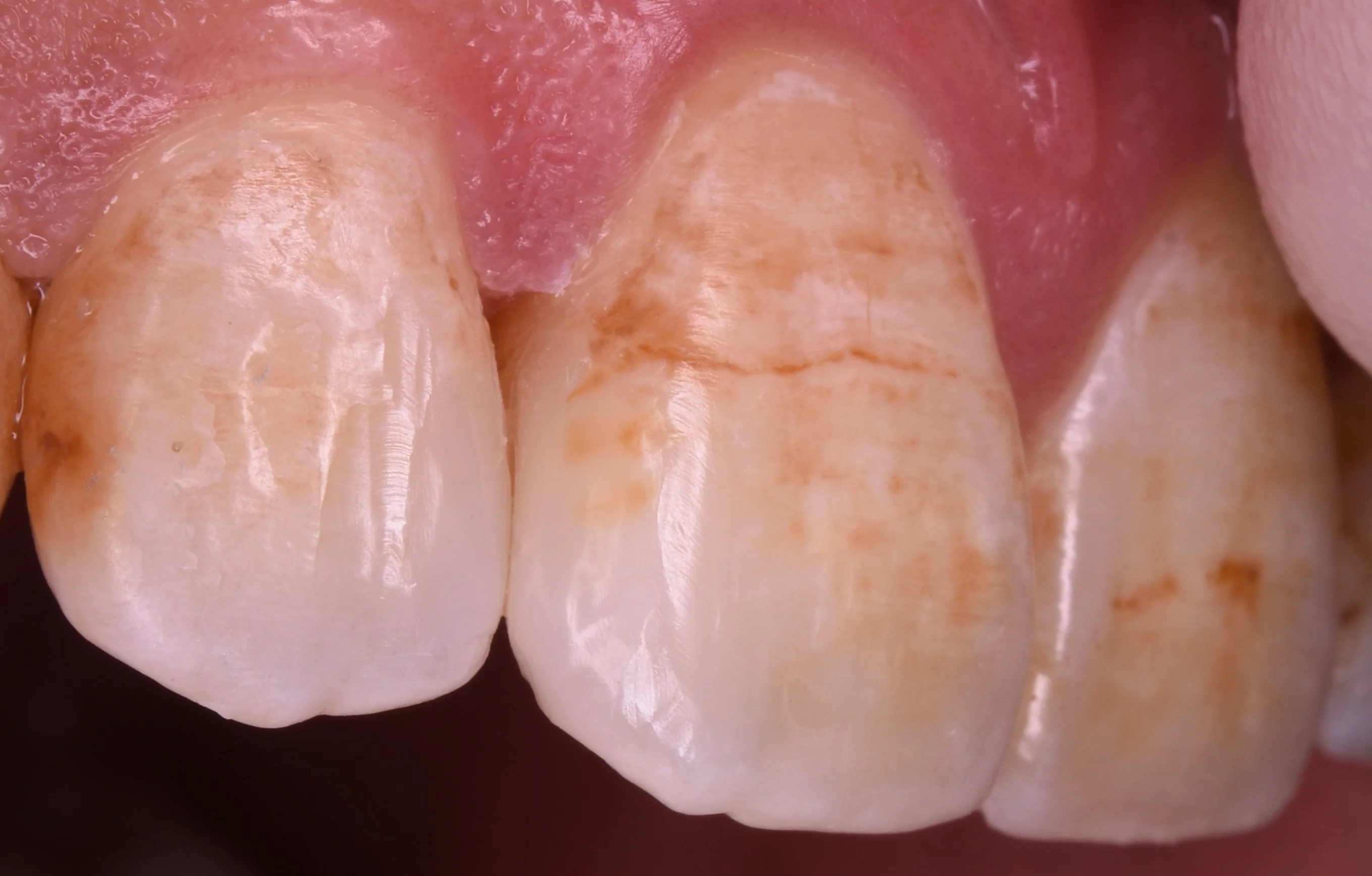 前歯の虫歯の治療で可能な限り歯を温存したケース。|坂寄歯科医院(取手市藤代) - 画像4